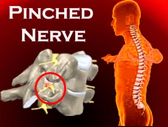 img-gitto-pinched-nerve.jpg